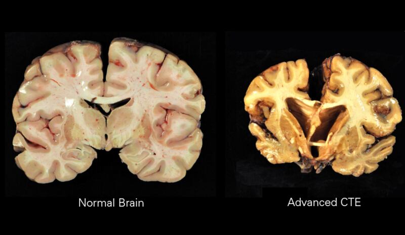 Chronic traumatic encephalopathy (CTE) as pictured here is a progressive brain disease caused by repeated head trauma, erodes the brain's structure, shrinks its size, and leads to memory loss, aggression, balance problems, and sleep disturbances, significantly affecting daily life and relationships.